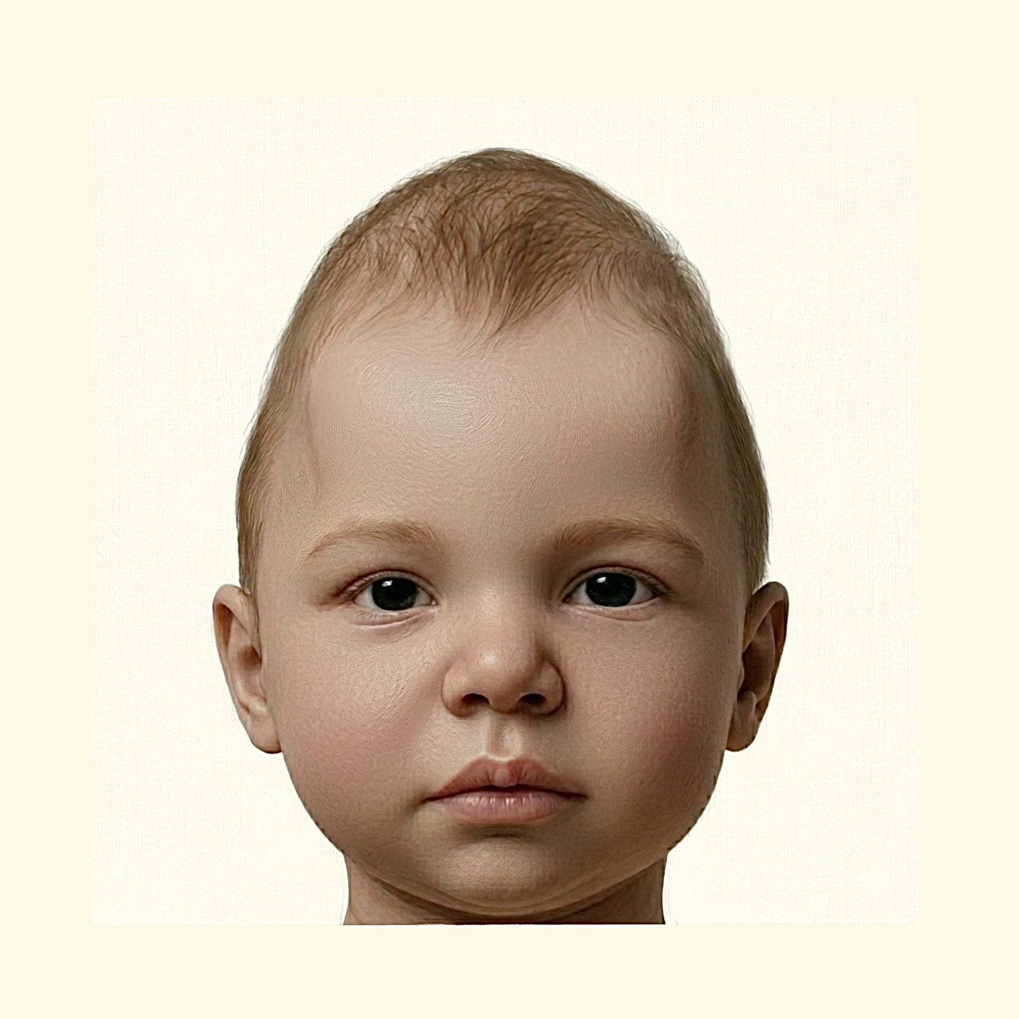 Craniosynostosis illustration